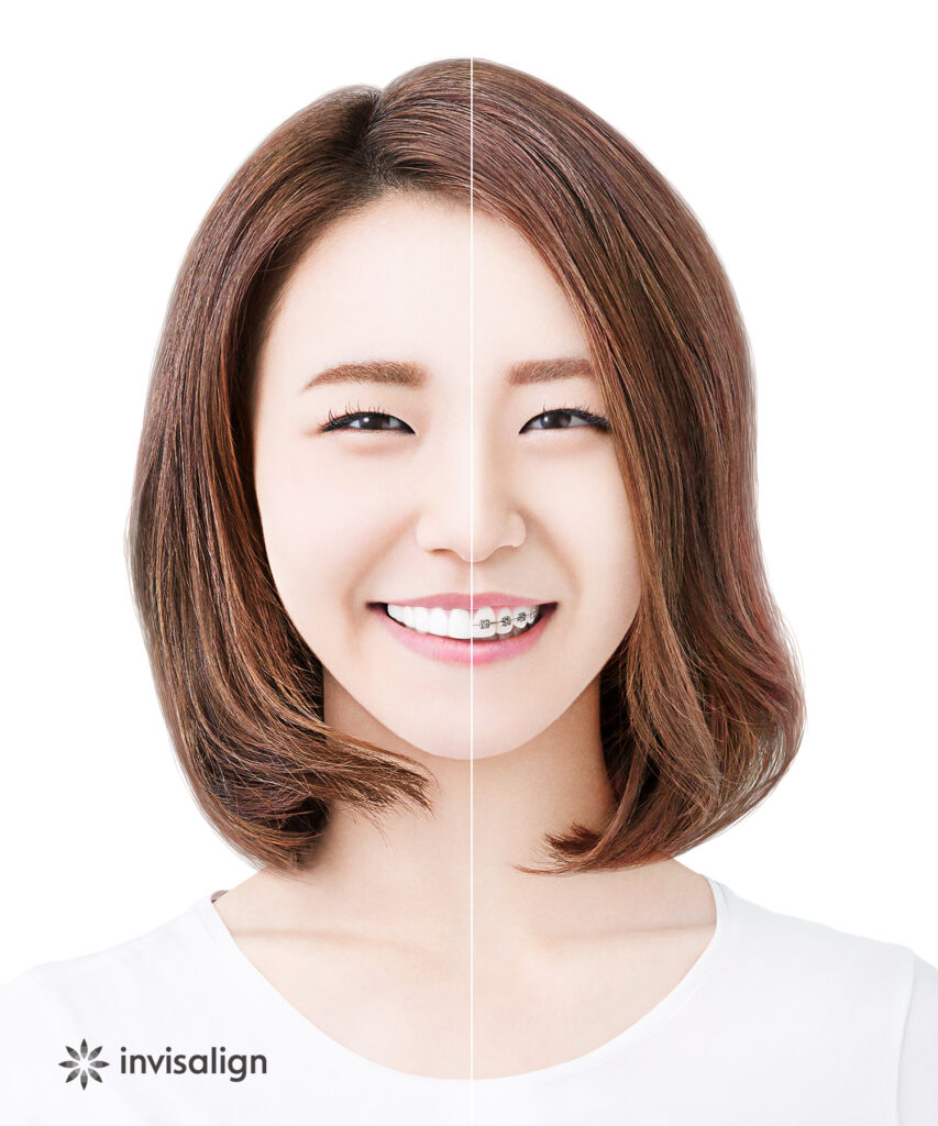 ワイヤー矯正と Invisalign 装着時の口元比較