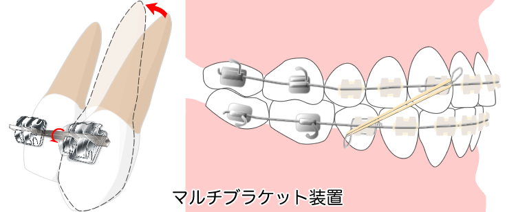 顎間ゴム