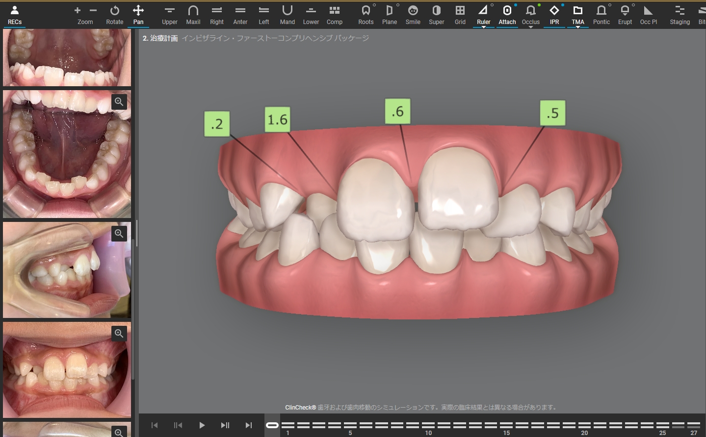 スクリーンショット_25-5-2024_171147_clincheck.invisalign.com_ - こむら矯正歯科 | 豊中