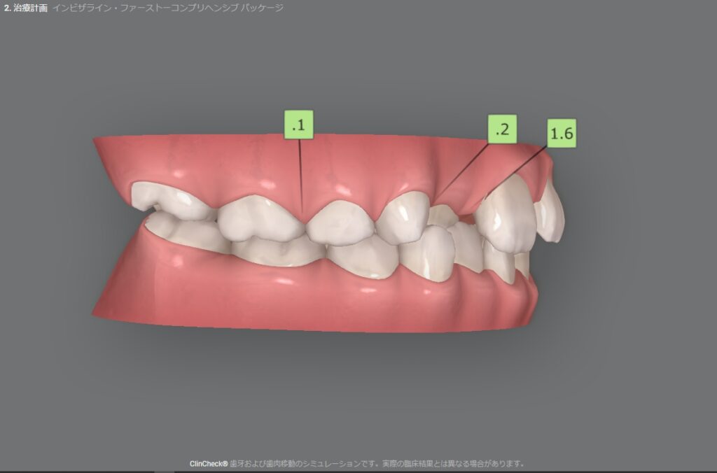 スクリーンショット_25-5-2024_17375_clincheck.invisalign.com_ - こむら矯正歯科 | 豊中