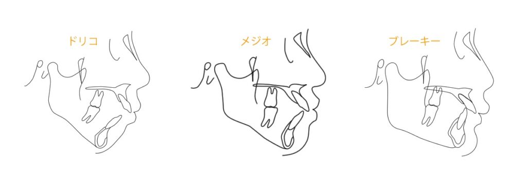 顔面タイプ8-2-1024x341 - こむら矯正歯科 | 豊中 人間の横顔