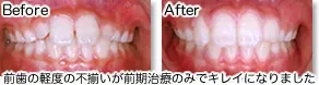 咬合誘導(部分非抜歯矯正)