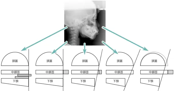 上顎前突の分類