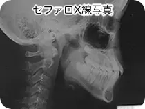 セファロ(頭部X線規格写真)
