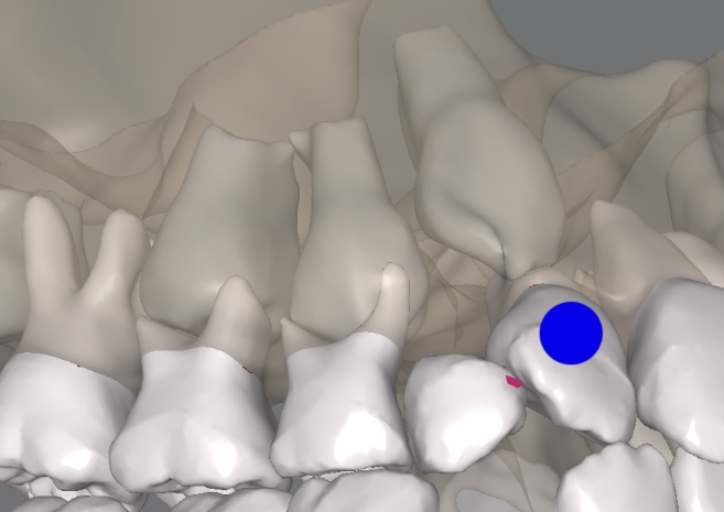 インビザライン